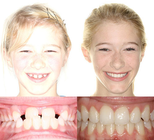 Before and after orthodontic treatment showing young patient's smile improvement and teeth alignment.