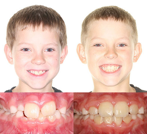 Before and after orthodontic treatment showing child's smile improvement and teeth alignment results.