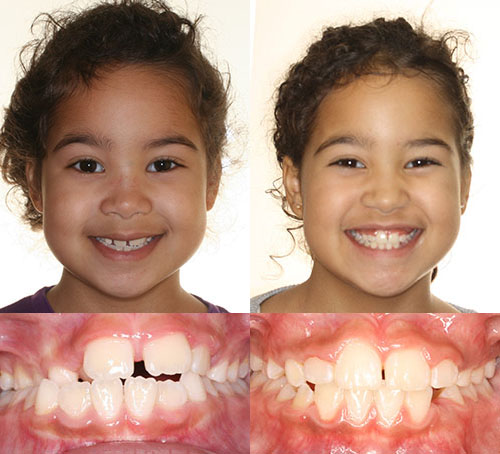 Two young girls smiling above dental X-rays showing orthodontic treatment progress.
