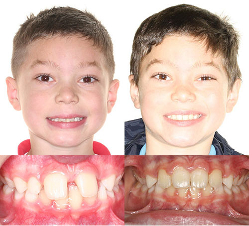 Two young boys smiling showing dental alignment before and after orthodontic treatment comparison.