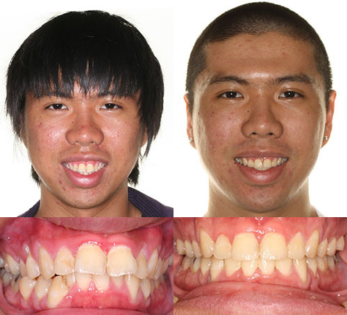 Before and after orthodontic treatment showing improved tooth alignment and bite correction.