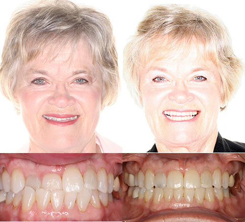 Before and after orthodontic treatment showing smiling woman's face and dental results.