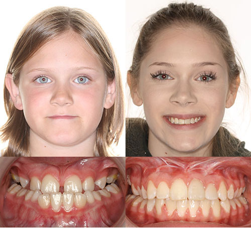 Before and after orthodontic treatment showing patient's smile transformation and dental alignment improvement.