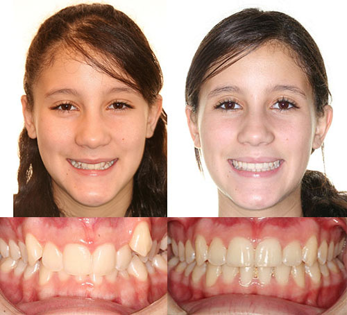 Before and after orthodontic treatment showing patient's smile transformation and teeth alignment improvement.