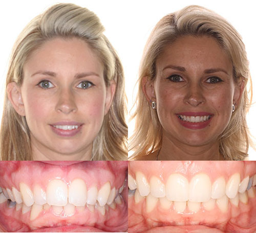 Before and after orthodontic treatment showing patient's smile transformation and improved tooth alignment.