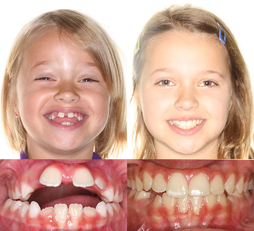 Before and after orthodontic treatment showing girl's smile and teeth transformation.