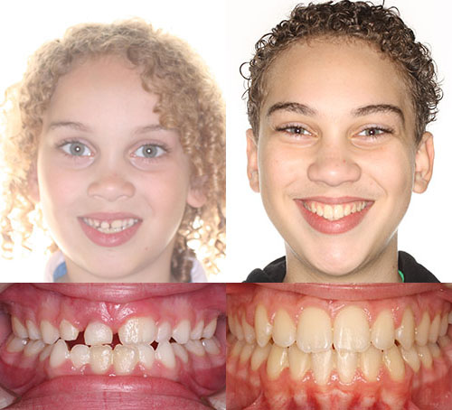 Before and after orthodontic treatment showing two patients' smiles and dental alignment results.