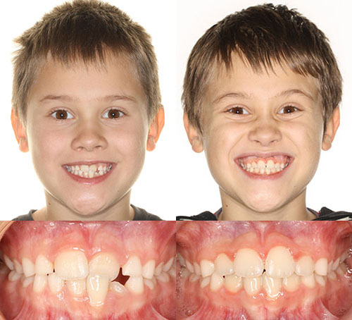 Two young boys displaying their smiles showing dental alignment before and after orthodontic treatment.