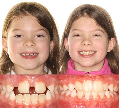 Two young girls showing before and after dental treatment results with improved teeth alignment and spacing.
