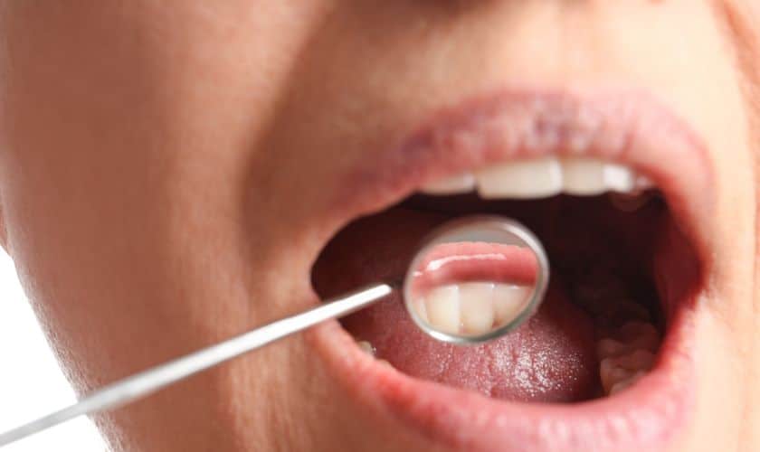 oral cancer